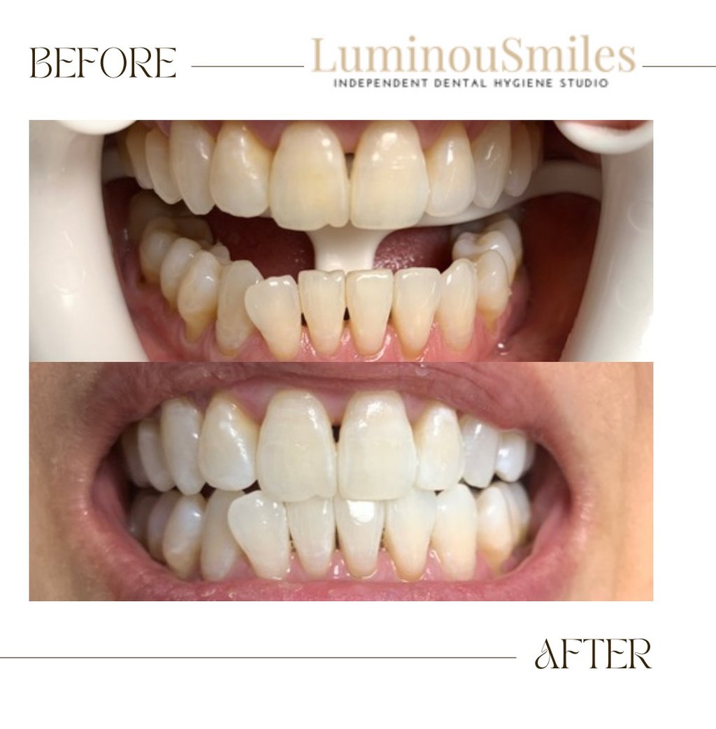 before and after whitening after in office whitening treatment 
