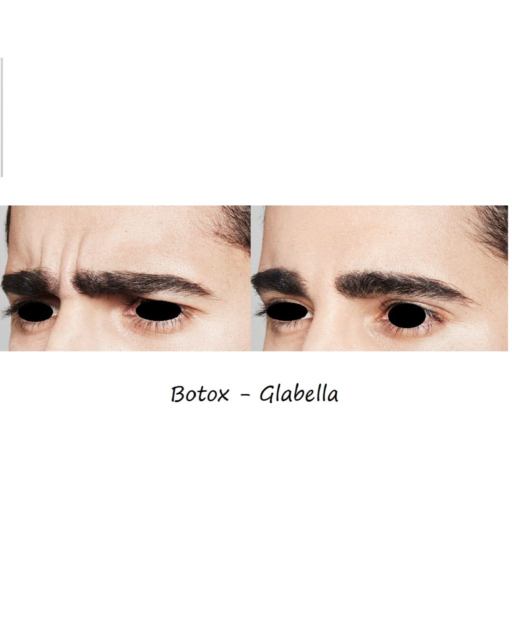 Before & after photos botox glabella – smoother worry wrinkles and relaxed, harmonious appearance.