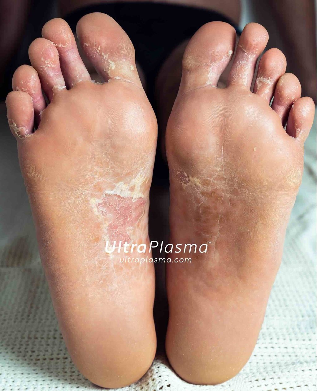 ultra_plasma_ultra_plazma_ultra-plasma_ultra-plazma_foot_fungus_ayak_mantari_tinea_pedis