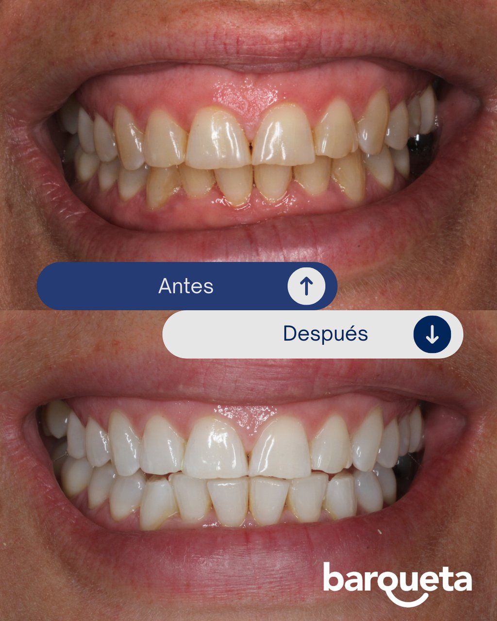 resultados naturales del blanqueamiento dental en sevilla