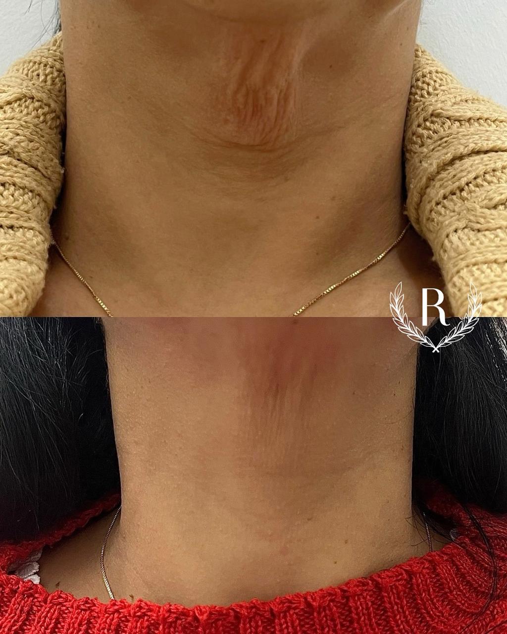 bioestimulador de colágeno aplicação facial - clínica estética Tatuapé