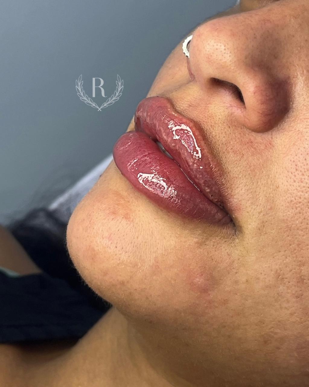 preenchimento facial com ácido hialurônico - Dra. Raphaela Dafne Tatuapé