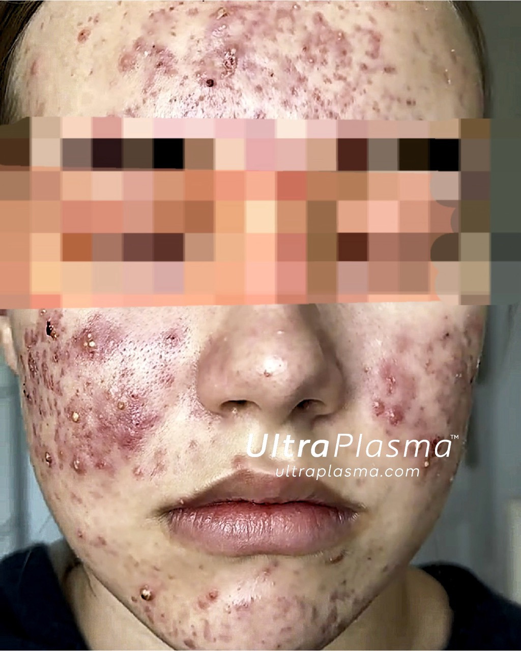akne_acne_ultra_plasma_ultra_plazma_ultra-plasma_ultra-plazma