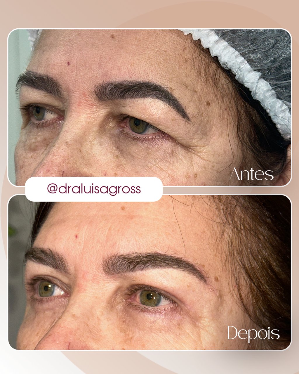 Antes e depois de cirurgia periocular realizada pela Dra. Luisa Gross