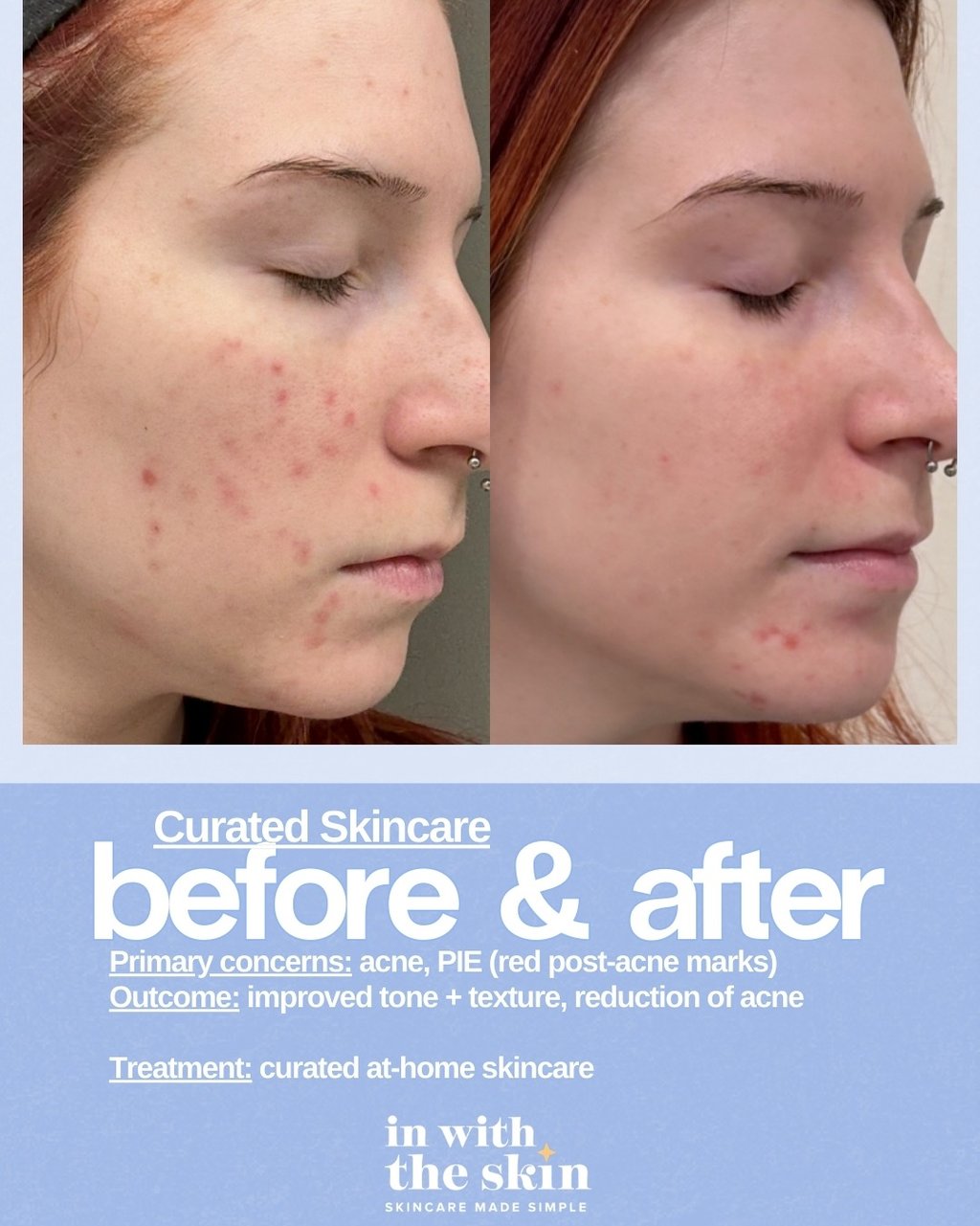 Before and after skincare results showing reduction in acne and red post-acne marks for improved skin texture.
