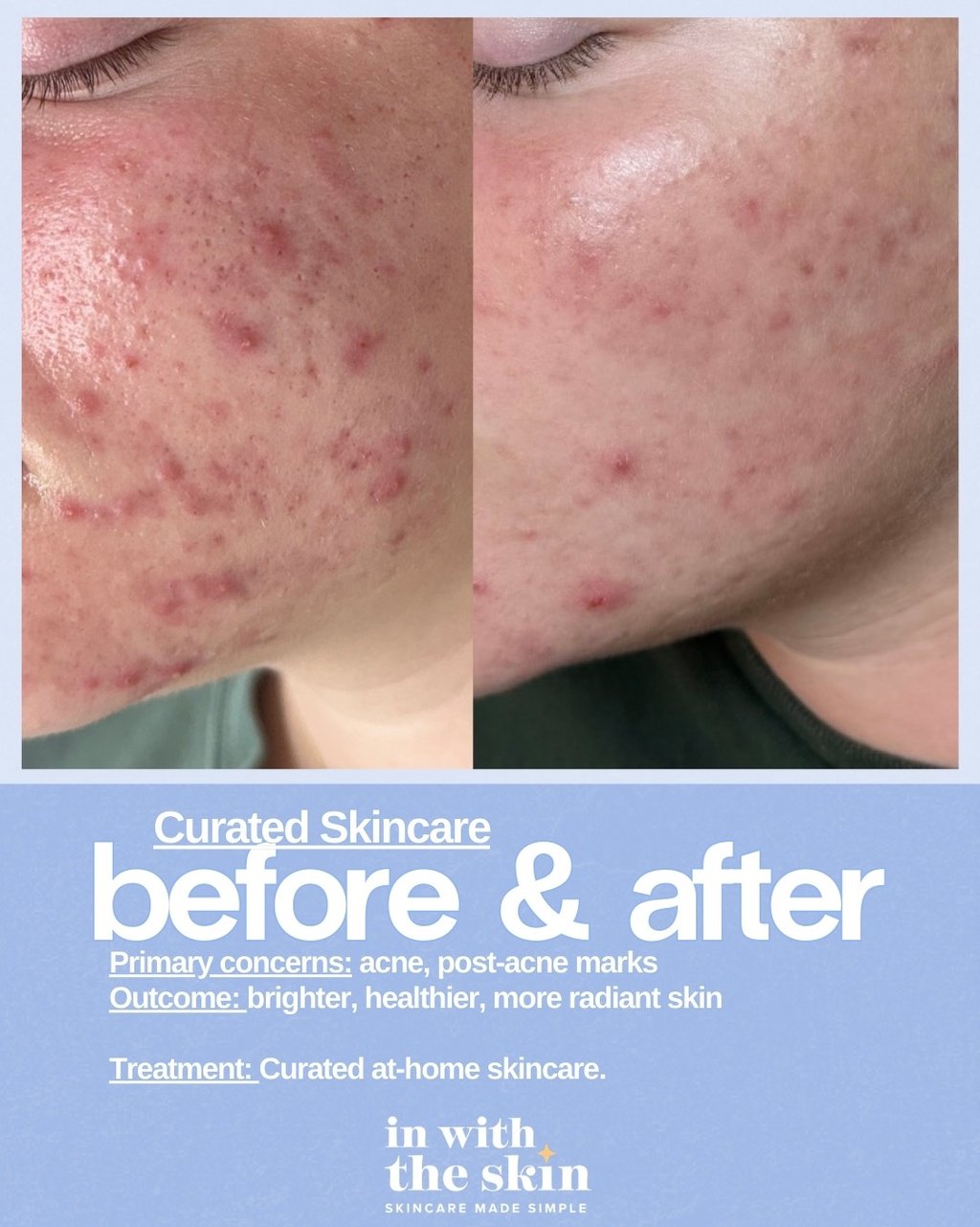 Before and after skincare results showing improvement in cystic acne and post-acne marks.