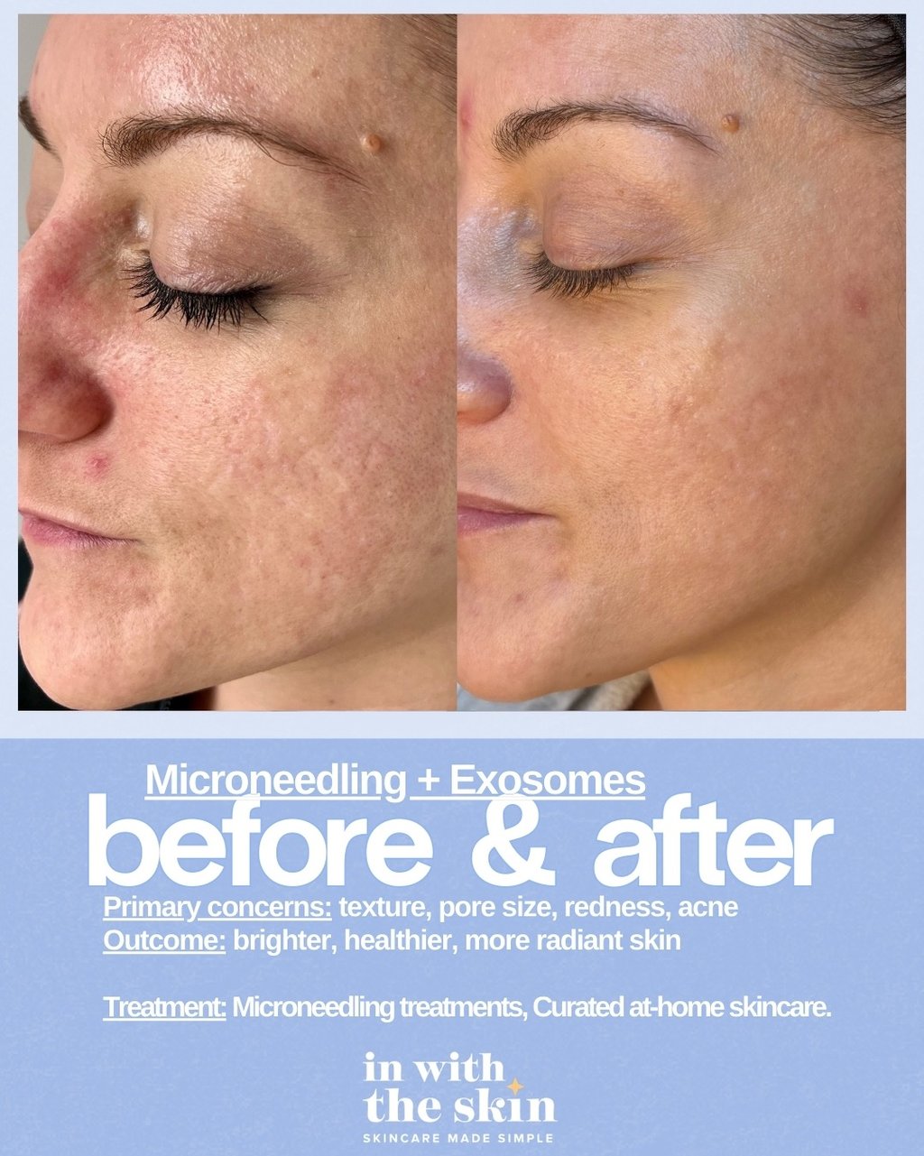 Microneedling and exosomes before and after results showing improved skin texture and reduced acne redness.