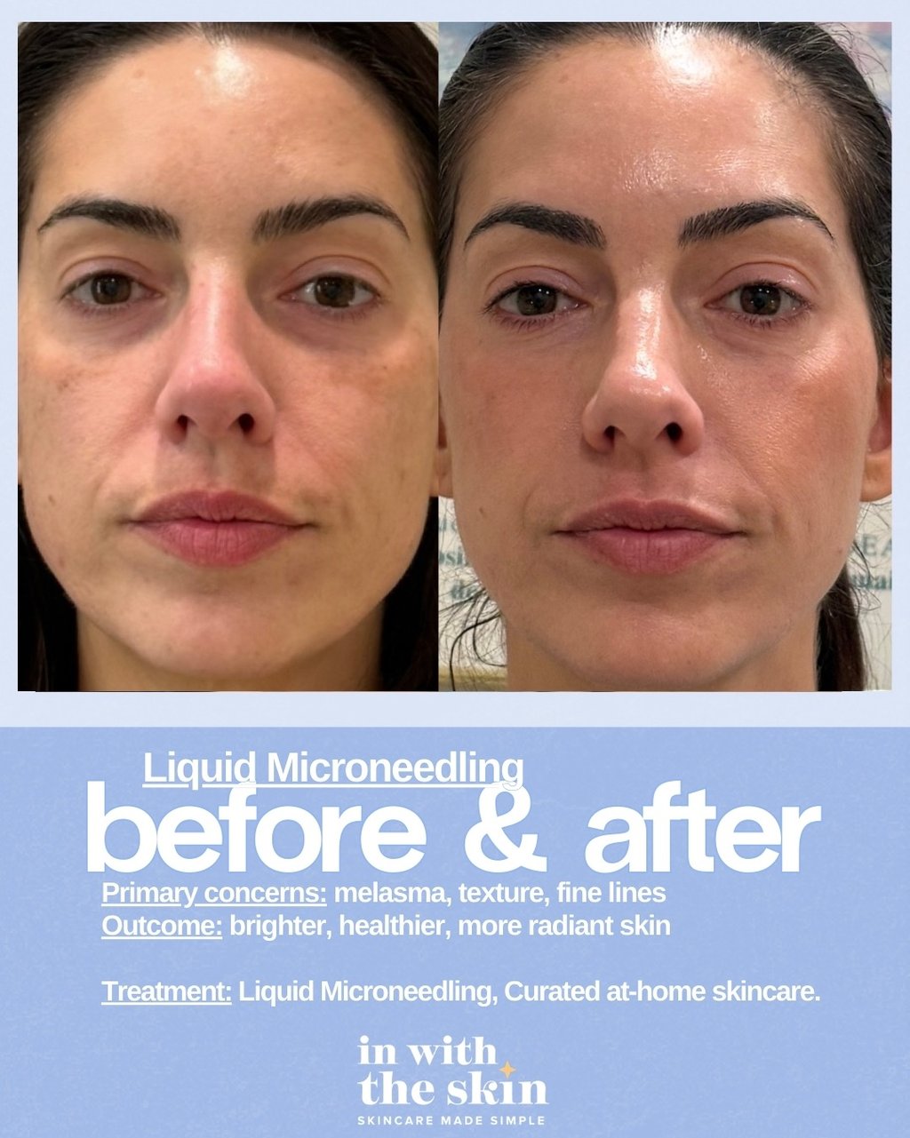 Before and after liquid microneedling treatment results for melasma, skin texture, and fine lines.