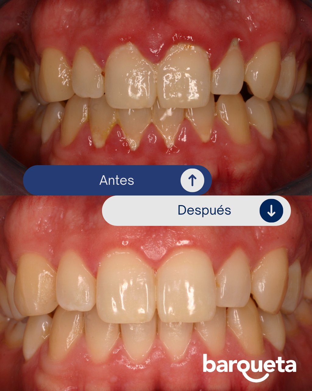 resultado tras tratamiento de periodoncia en sevilla