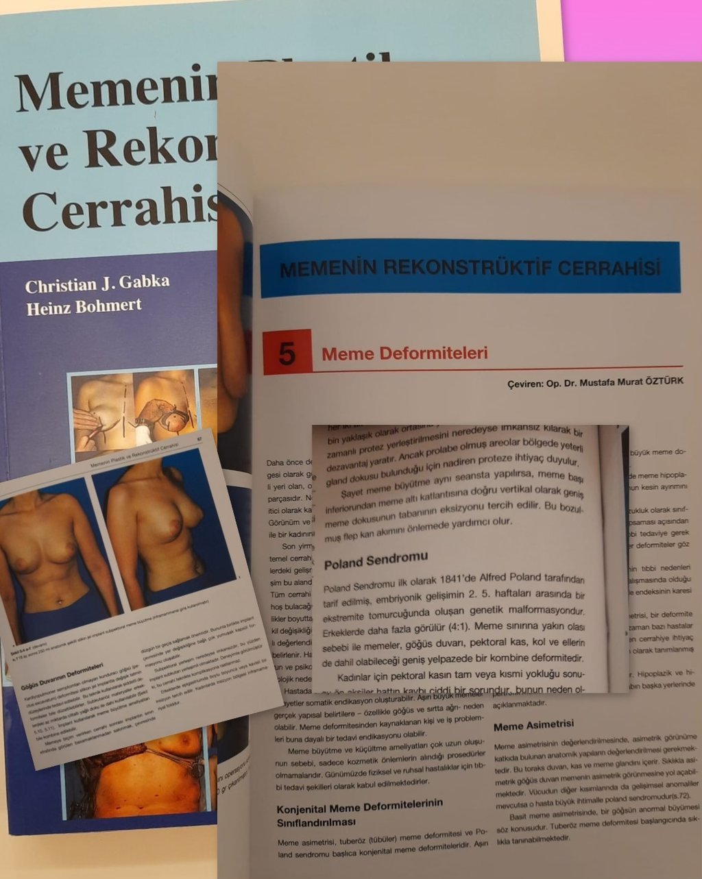 Meme Estetik ve Rekonstrüktif Cerrahi Kitabı, Poland Sendromu, Tübüler meme, Tüberoz meme bölümleri 