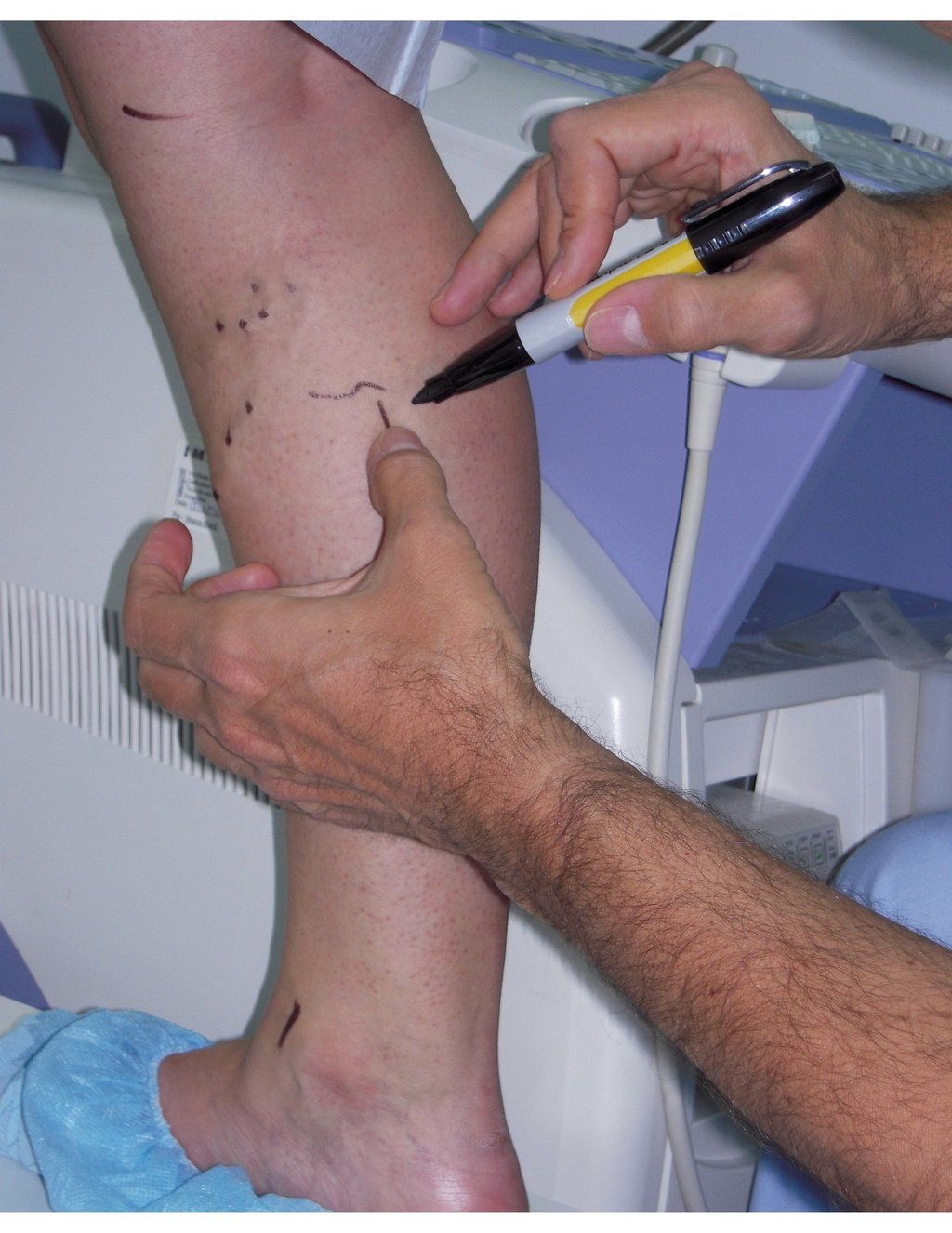vascular ultrasound venous skin marking varicose veins surgery pre operative mapping vein skin imaging treatment leg swelling