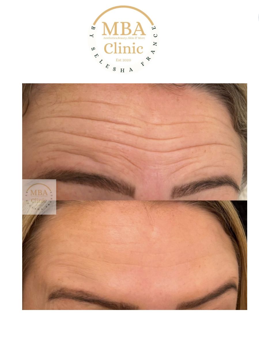 Botox and fillers in Hull 