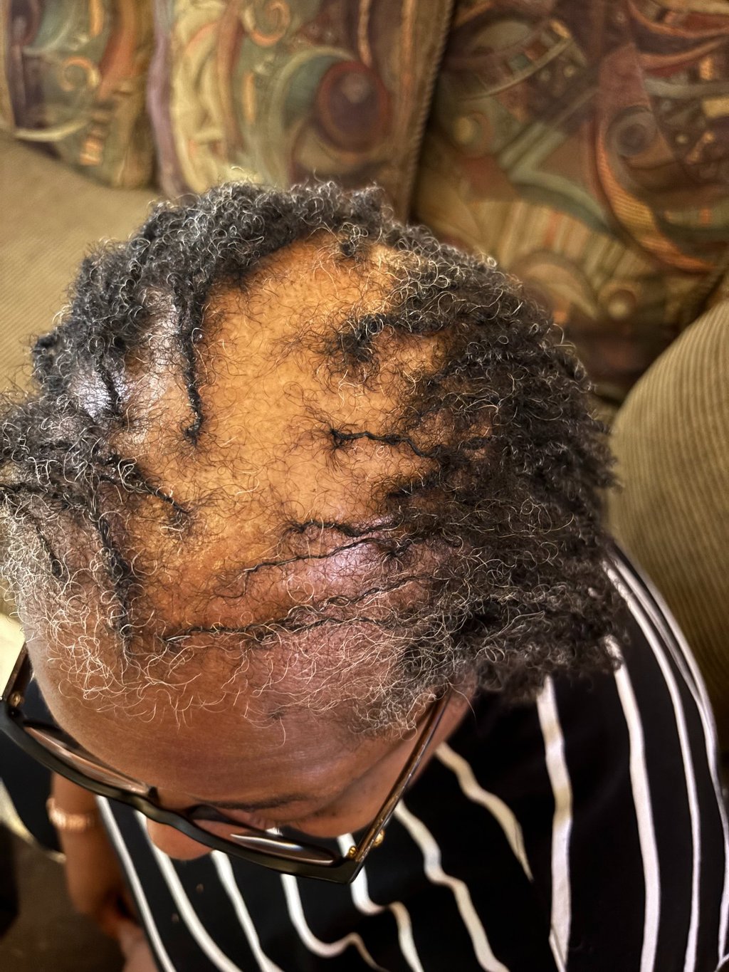 Close-up of a person with thinning graying hair and visible scalp showing signs of female pattern baldness or alopecia.