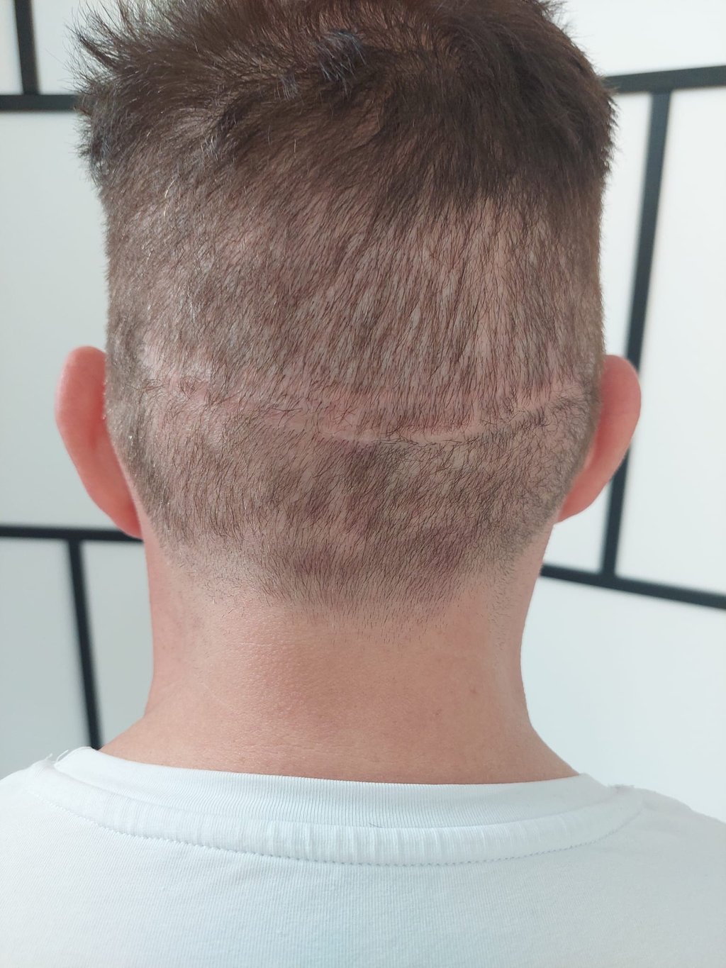 chomme qui a une cicatrice sur le cuir chevelu à cause d'une greffe capillaire