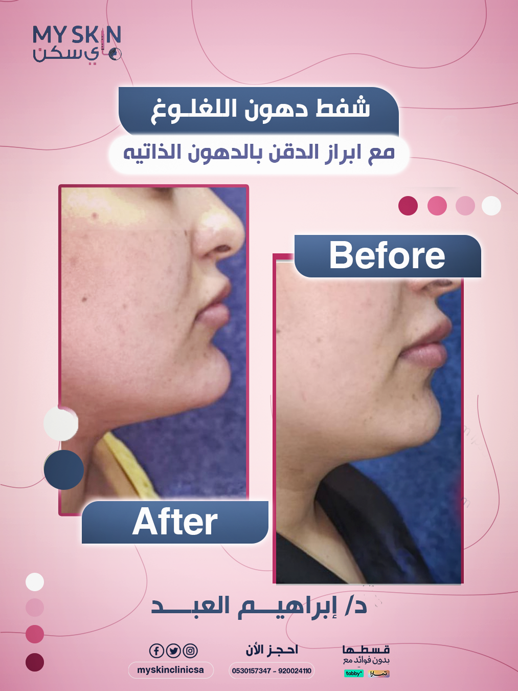 شفط اللغلوغ  مع الدكتور ابراهيم العبد