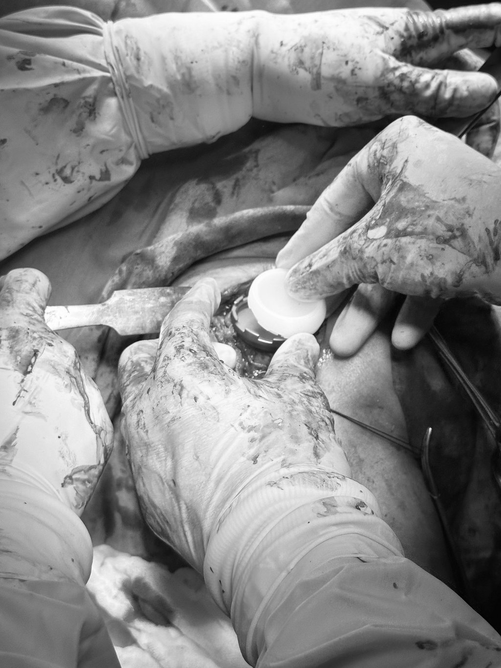 Colocación de vastago de húmero en prótesis reversa de hombro.