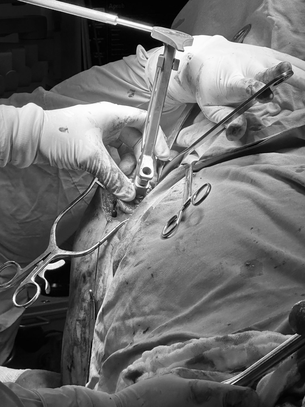 Preparación de canal medular de húmero en prótesis reversa de hombro