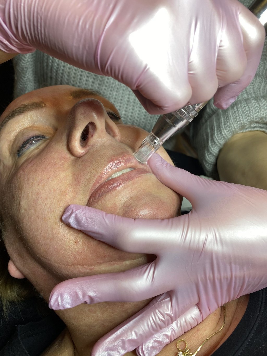 microneedling is de beste anti-age gezichtsbehandeling