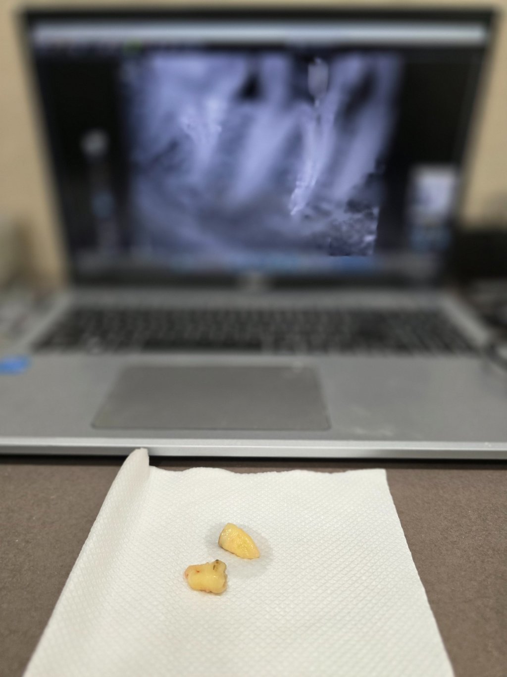 Painless wisdom tooth extraction in Wakad