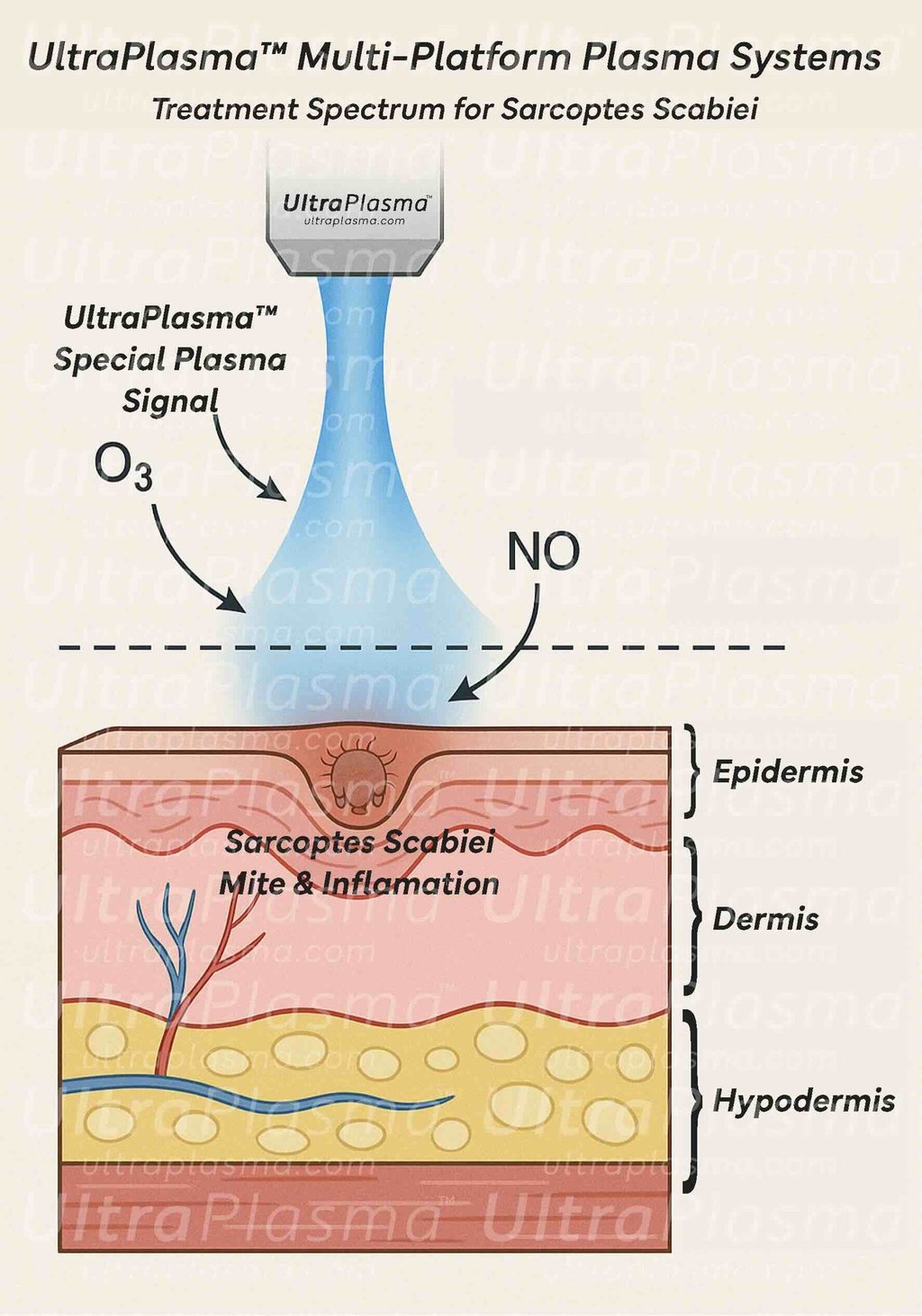 ultraplasma.com_Sarcoptes_scabiei_Infestation_Treatment_ultra_plasma_ultra_plazma