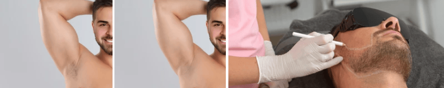 side by site pictutes laser bear definition and before and after men under arms laser