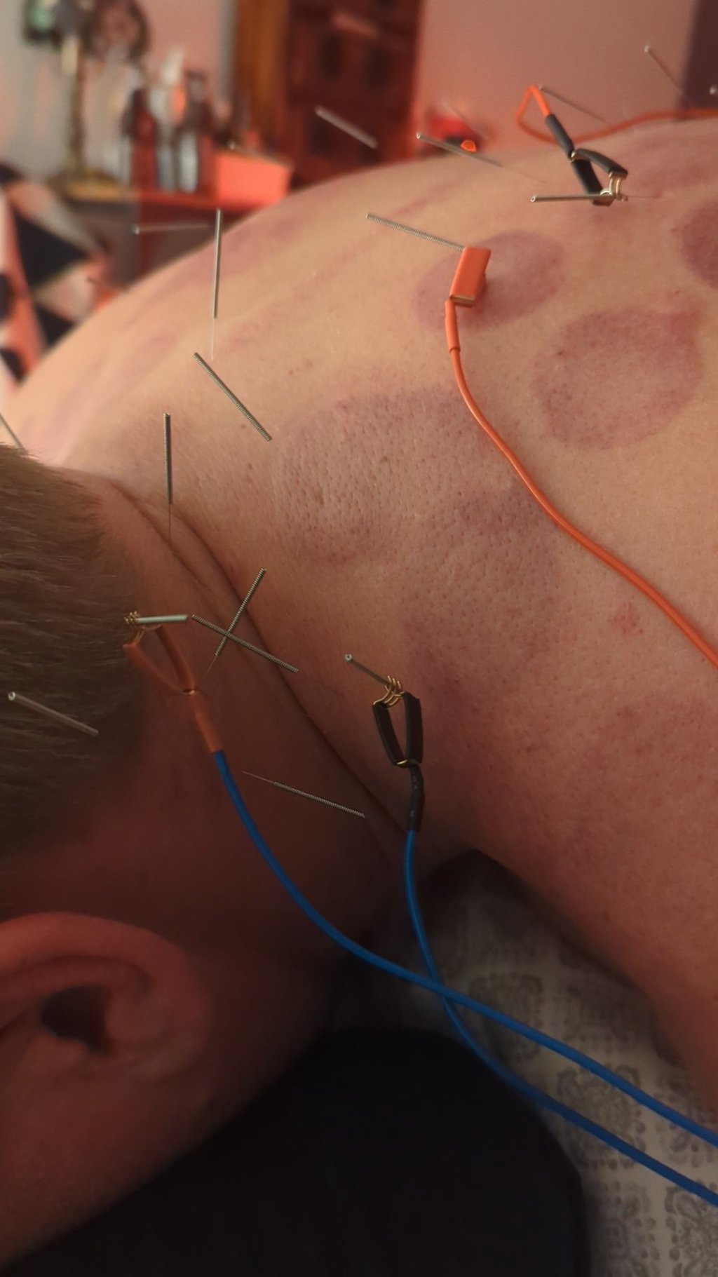 Electroacupuncture treatment on a patient's back with needles, wires, and cupping marks for pain relief.