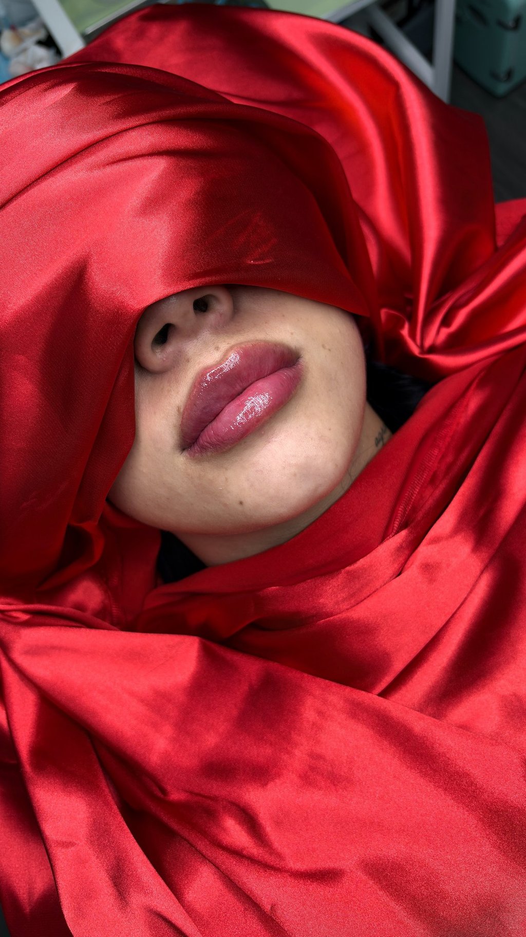 alt="resultados después relleno de labios"