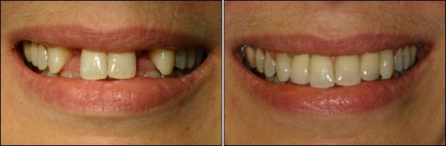 Dental implants Santiago Dominican Republic