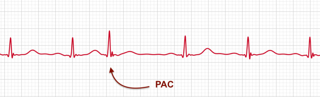 Apple Watch ECG strip showing a Premature Atrial Contraction (PAC) identified with a red arrow.