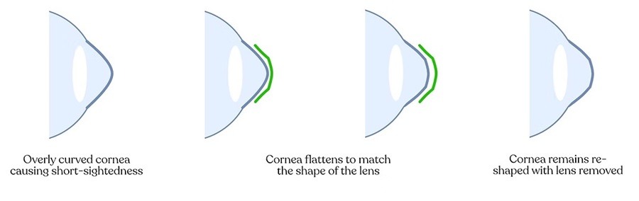 orthokeratology-cornea-reshaping-overnight