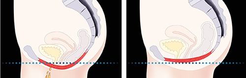 pelvic floor showing weakened versus strengthened muscles