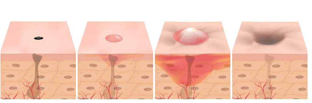 acne scar formation singapore