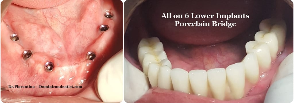 Puente de porcelana fijo sobre implantes