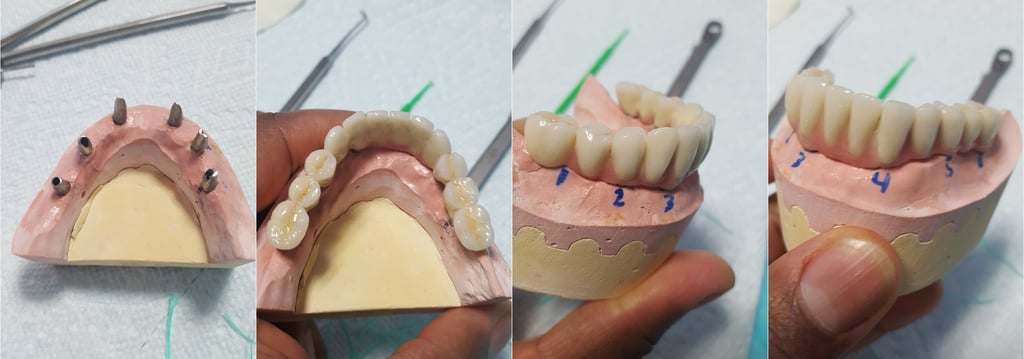 Puente porcelana sobre implantes