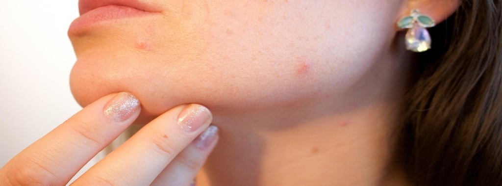 Acne on girl's face