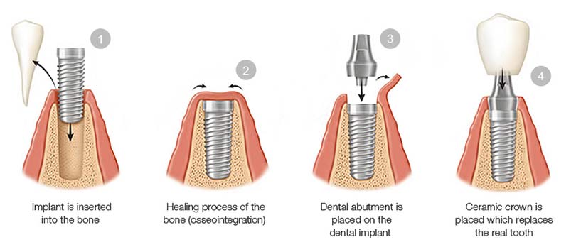 Dental implant steps Santiago Dominican Republic