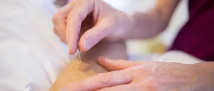 Acupuncture 