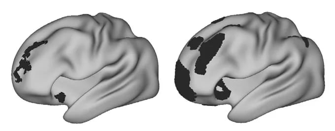 Brain MRI shows differences in the brain of a person with depression.