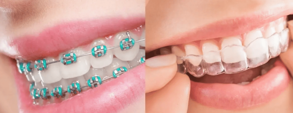 الفرق بين التقويم العادي والشفاف