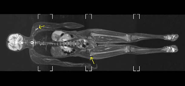 MRI full body scan
