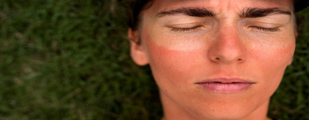 Woman with sunburn skin