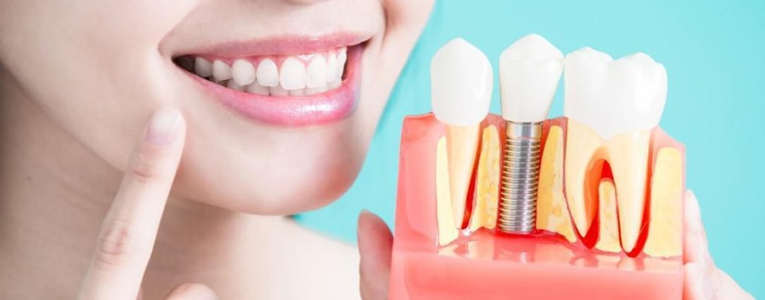 Smiling Woman and dental model with dental implant