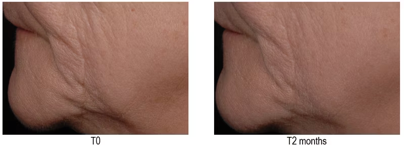 a woman's neck and neck area before and after a lip injection