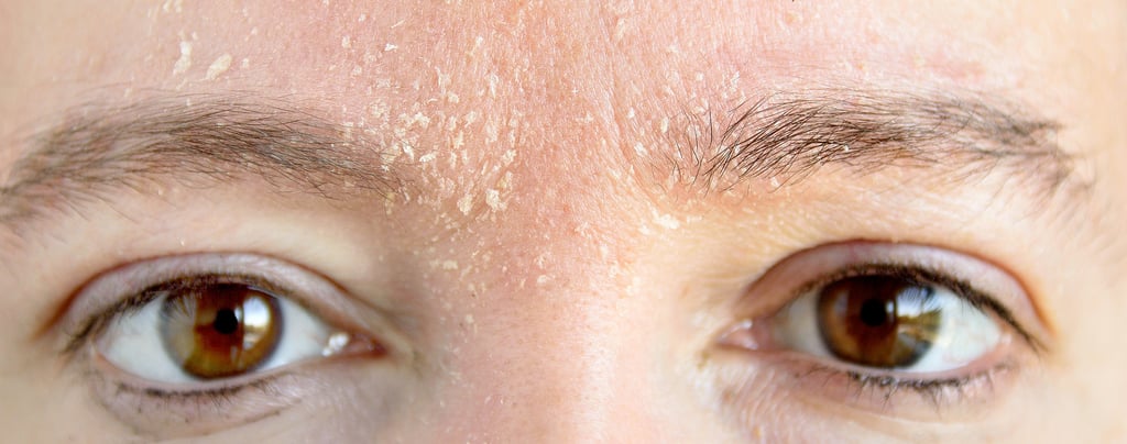 kuru cilt döküntü