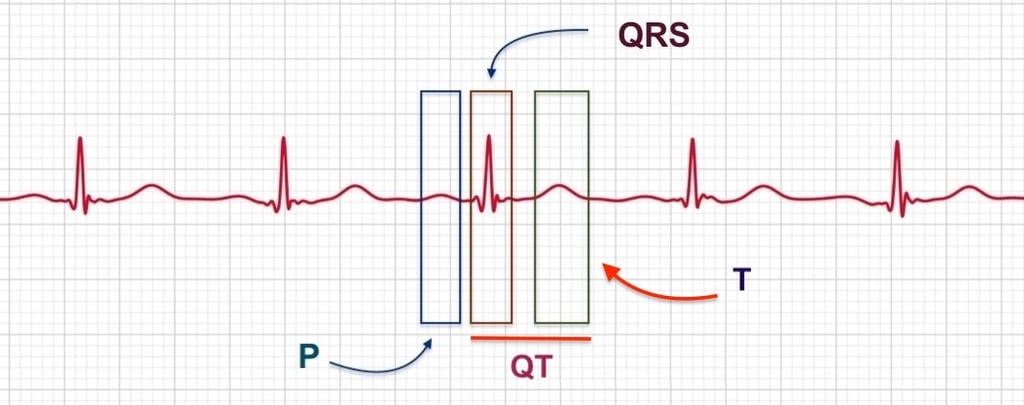 Electrocardiogram ECG chart labeled with P, QRS, and T waves plus QT interval on a grid.