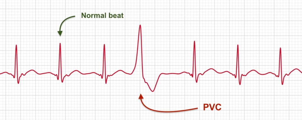 A Premature Ventricular Contraction (PVC) is marked on Apple Watch ECG report