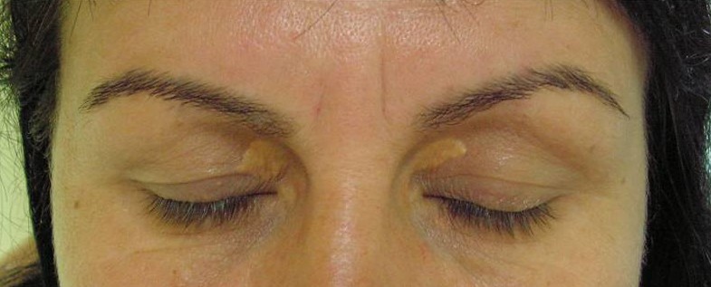 tratament xantelasme depozite colesterol