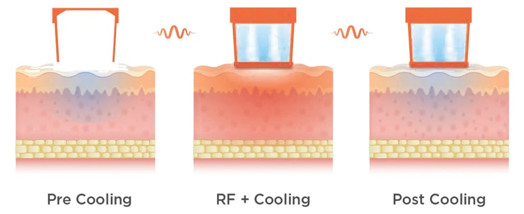 oligio monopolar radiofrequency skin tightening