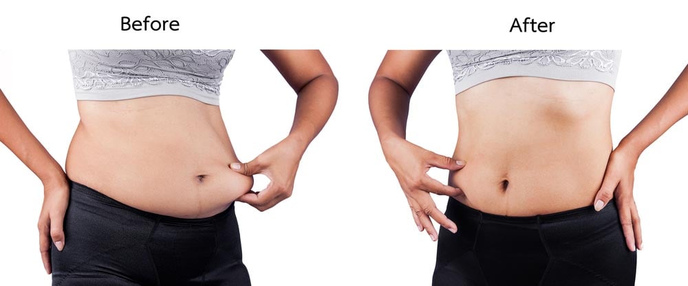 a woman's butt showing before and after her belly lift