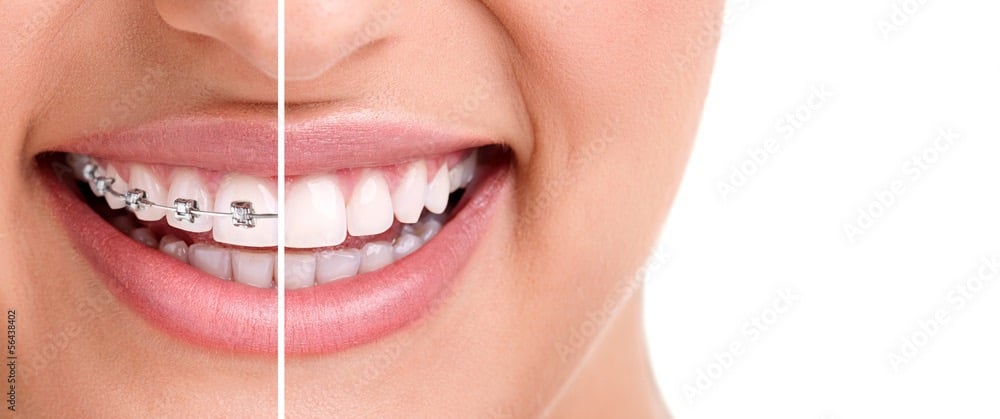 a woman with braces and braces on her teeth